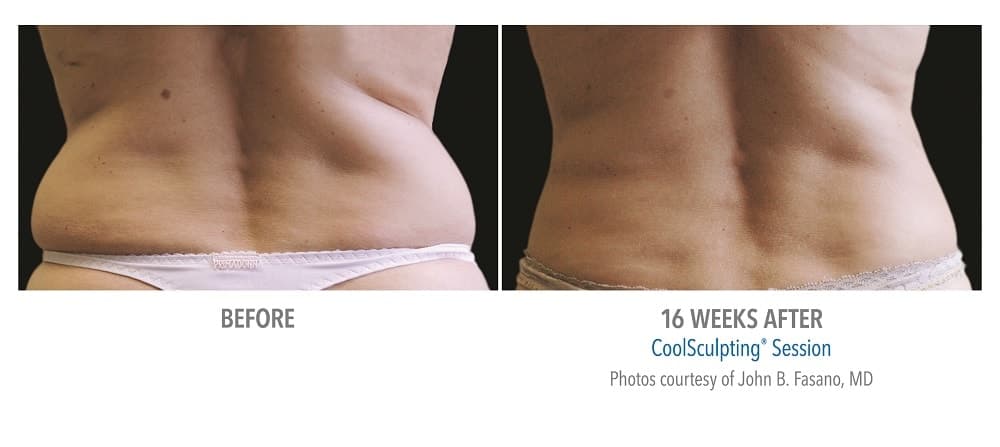 CoolSculpting by Zeltiq - Non-Surgical Fat Reduction - Bronx 