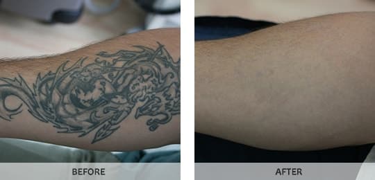 Laser Tattoo Removal in Bronx Westchester New York NY by Studio ...