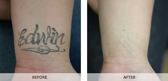 Laser Tattoo Removal New York Indiana Jones Beach