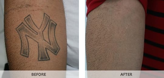 Laser Tattoo Removal in Bronx Westchester New York NY by Studio ...